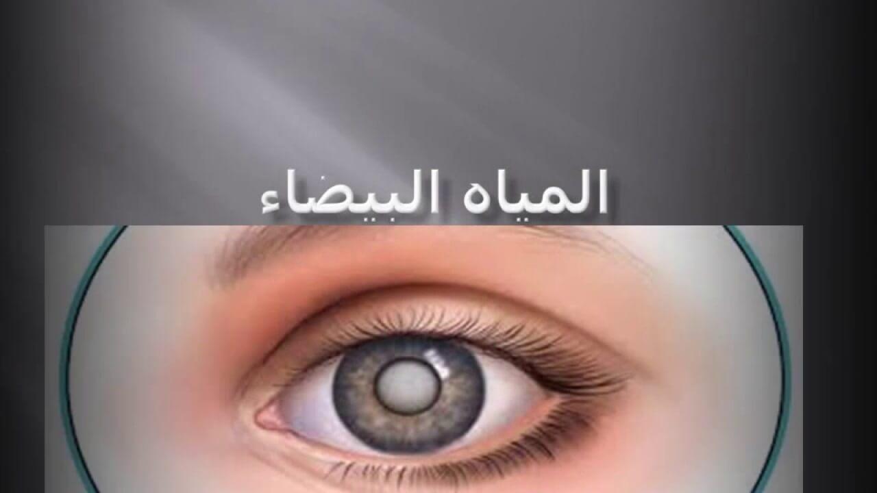 المياه البيضاء - الاسباب والعلاج